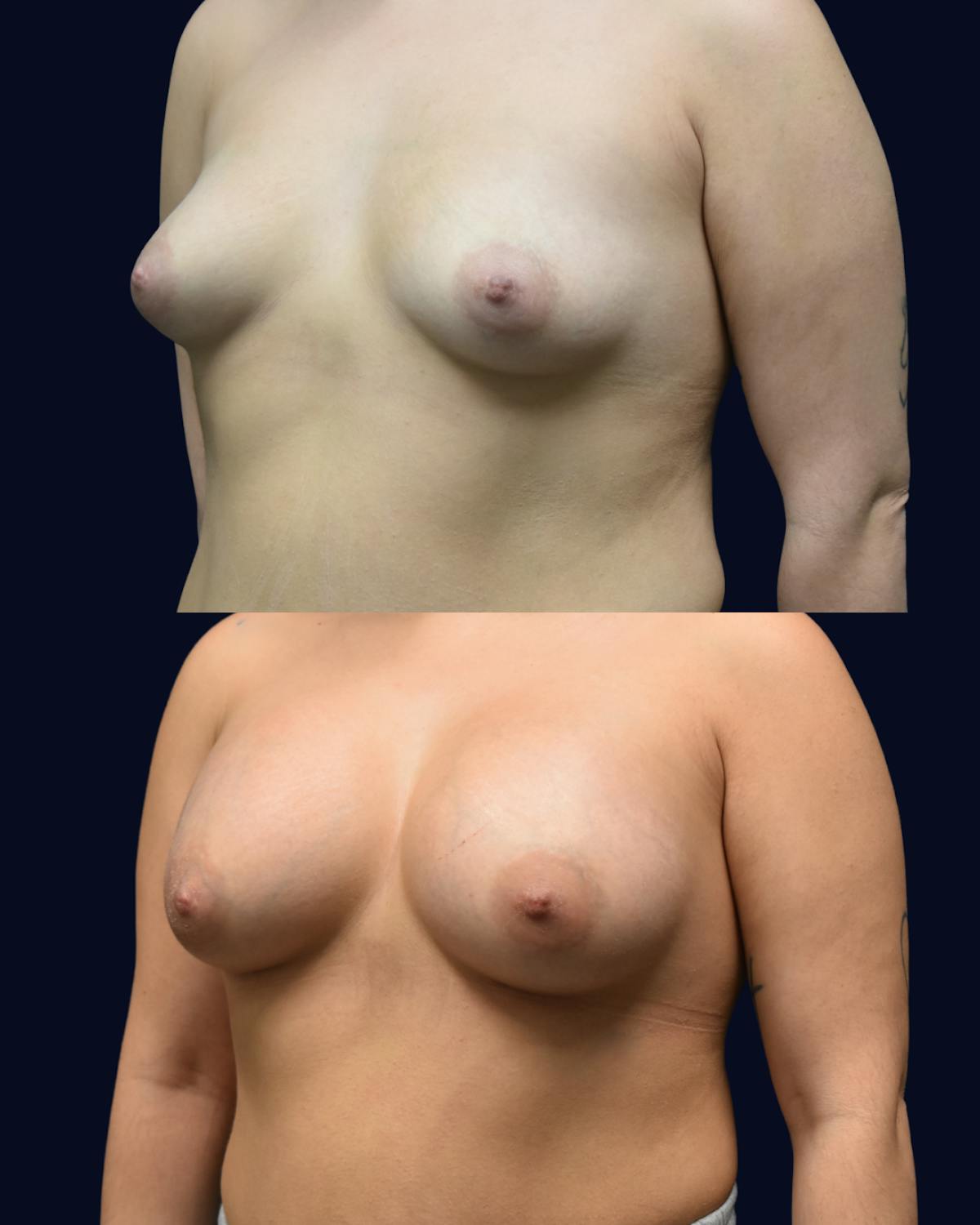 Breast Augmentation Before & After Gallery - Patient 685777 - Image 2