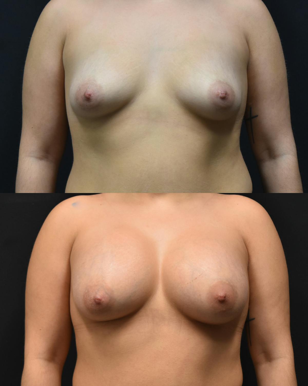 Breast Augmentation Before & After Gallery - Patient 685777 - Image 1