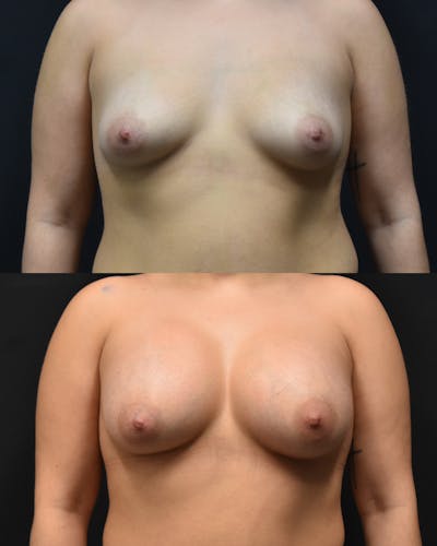 Breast Augmentation Before & After Gallery - Patient 685777 - Image 1