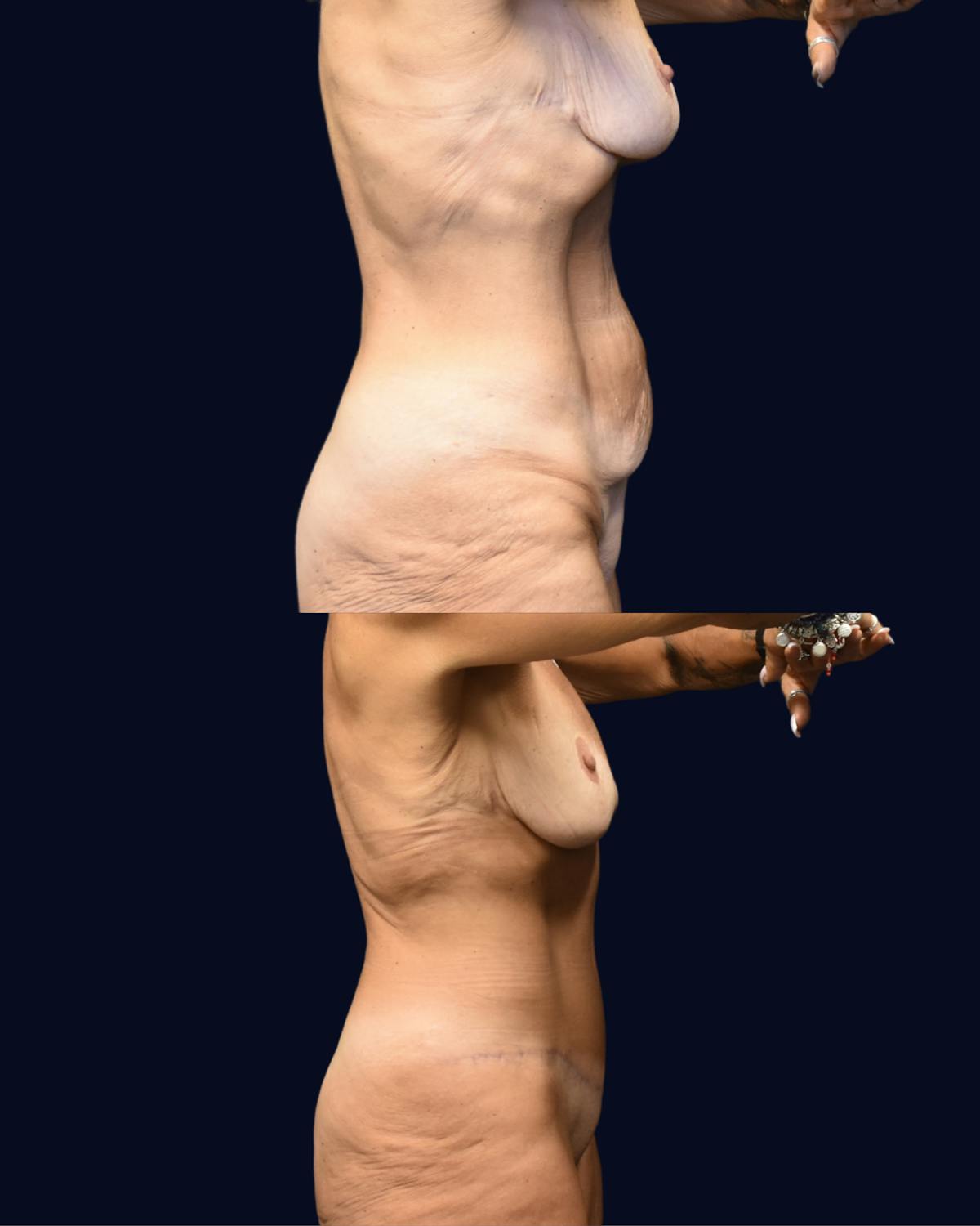 Abdominoplasty (Tummy Tuck) Before & After Gallery - Patient 304007 - Image 3