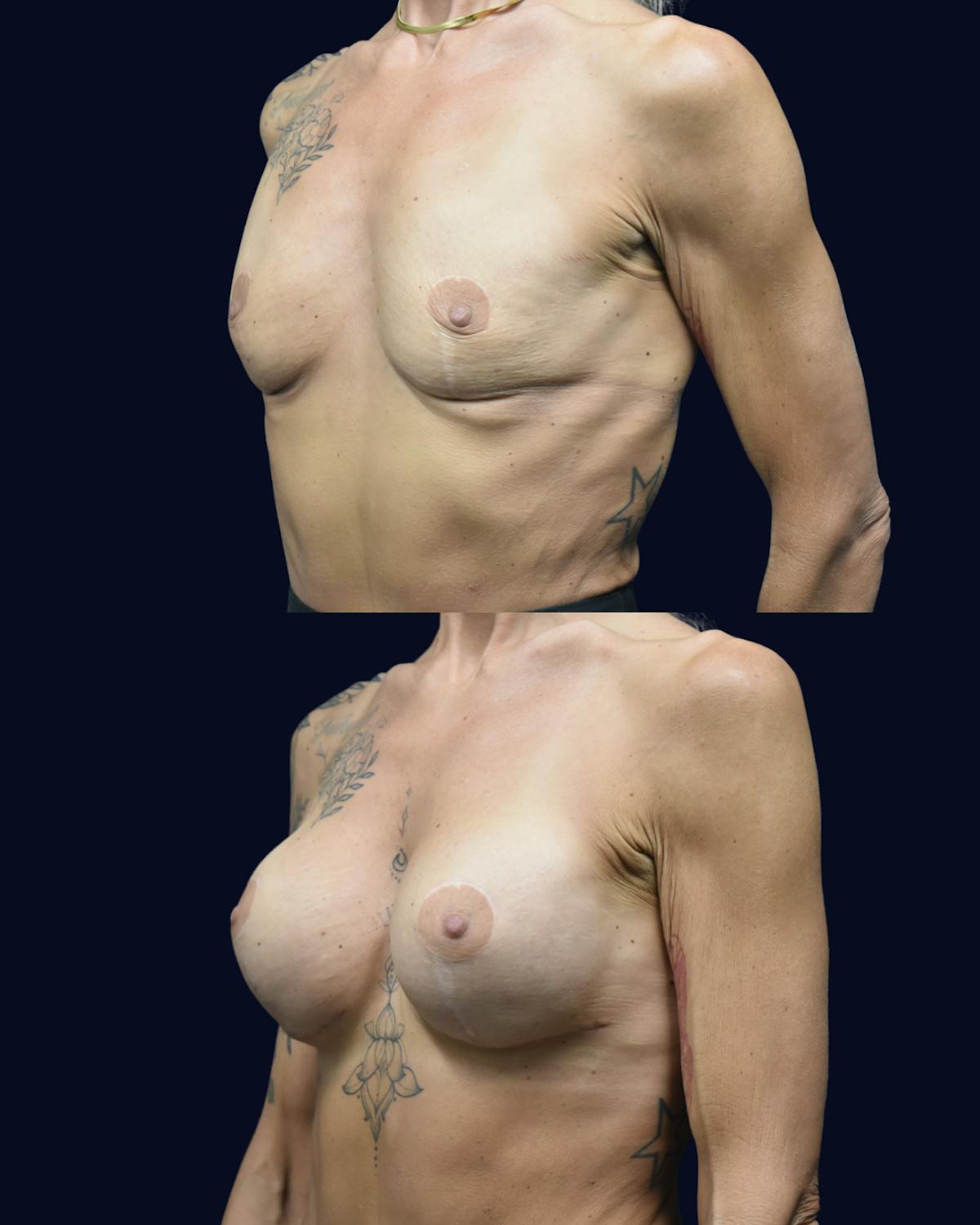 Breast Augmentation Before & After Gallery - Patient 554191 - Image 2