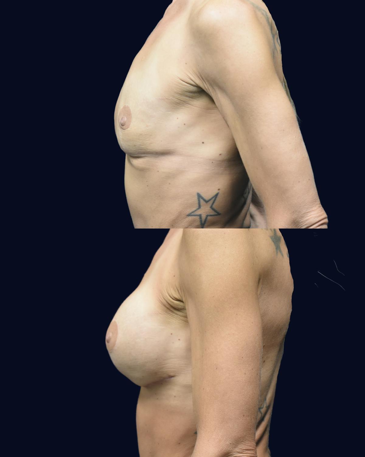 Breast Augmentation Before & After Gallery - Patient 554191 - Image 3