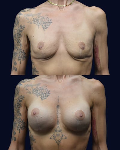 Breast Augmentation Before & After Gallery - Patient 554191 - Image 1