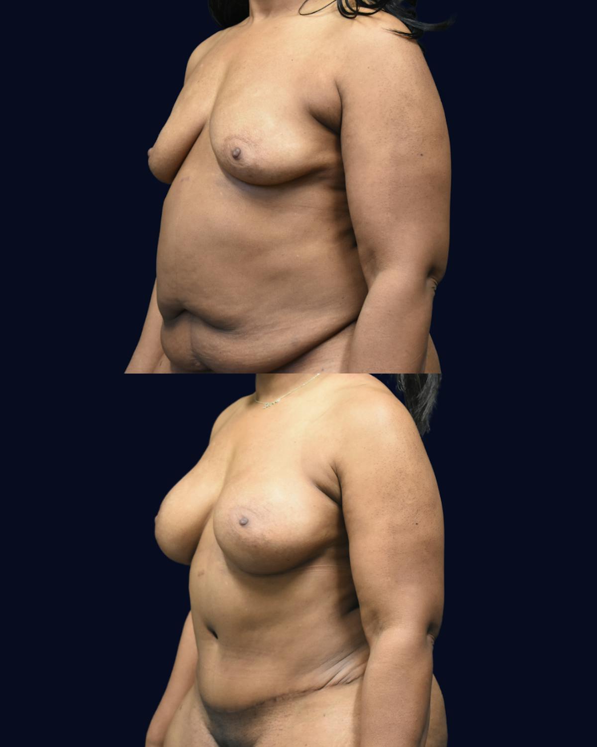 Mommy Makeover Before & After Gallery - Patient 290935 - Image 2