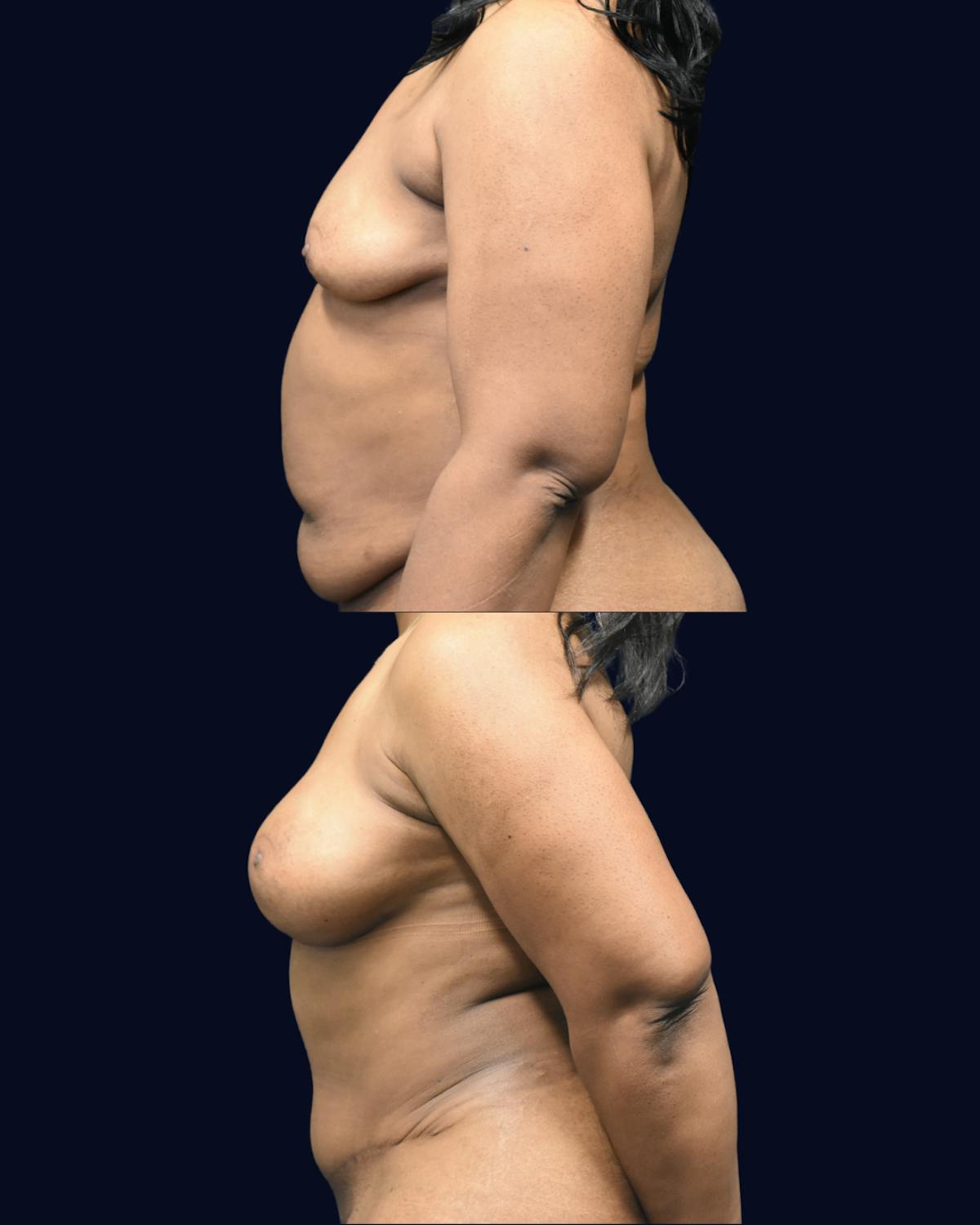 Mommy Makeover Before & After Gallery - Patient 290935 - Image 3