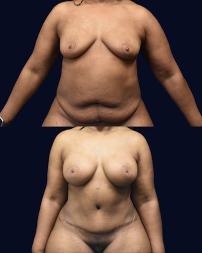 Mommy Makeover Before & After Gallery - Patient 290935 - Image 1