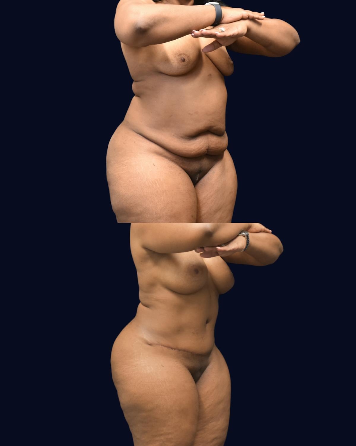 Mommy Makeover Before & After Gallery - Patient 290935 - Image 5