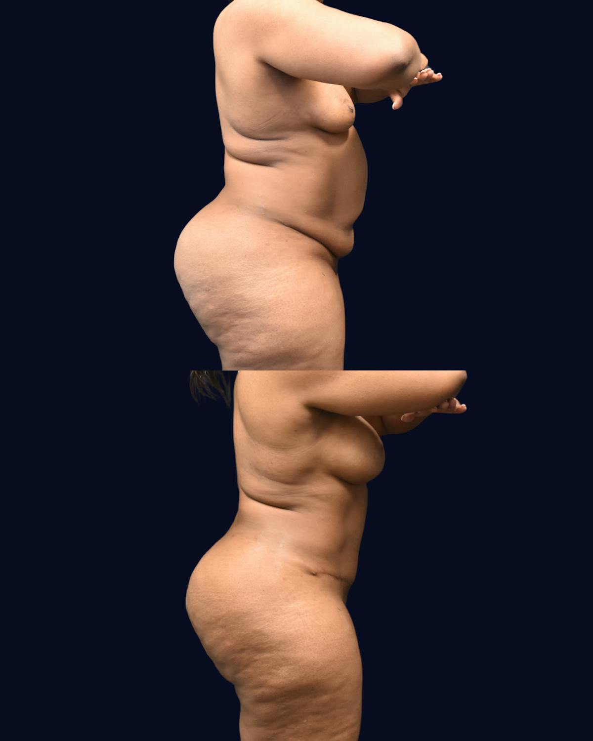 Mommy Makeover Before & After Gallery - Patient 290935 - Image 6