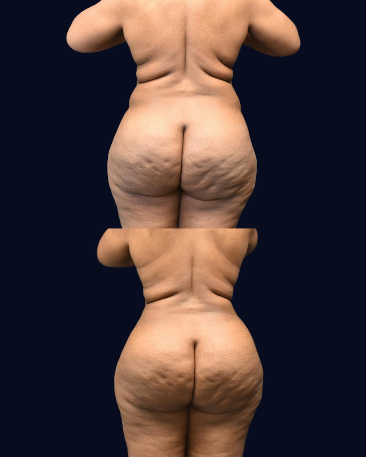 Mommy Makeover Before & After Gallery - Patient 290935 - Image 7