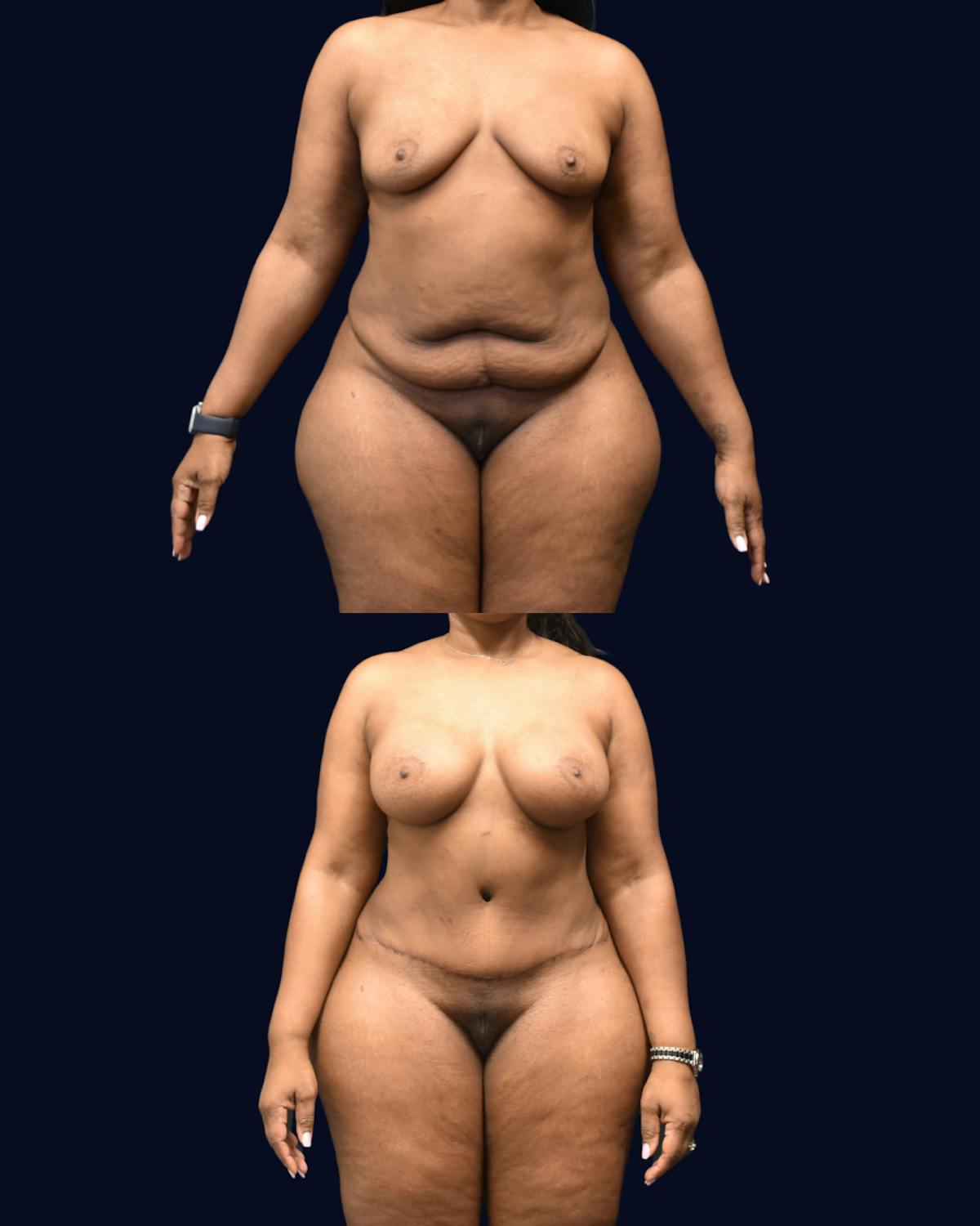 Mommy Makeover Before & After Gallery - Patient 290935 - Image 4