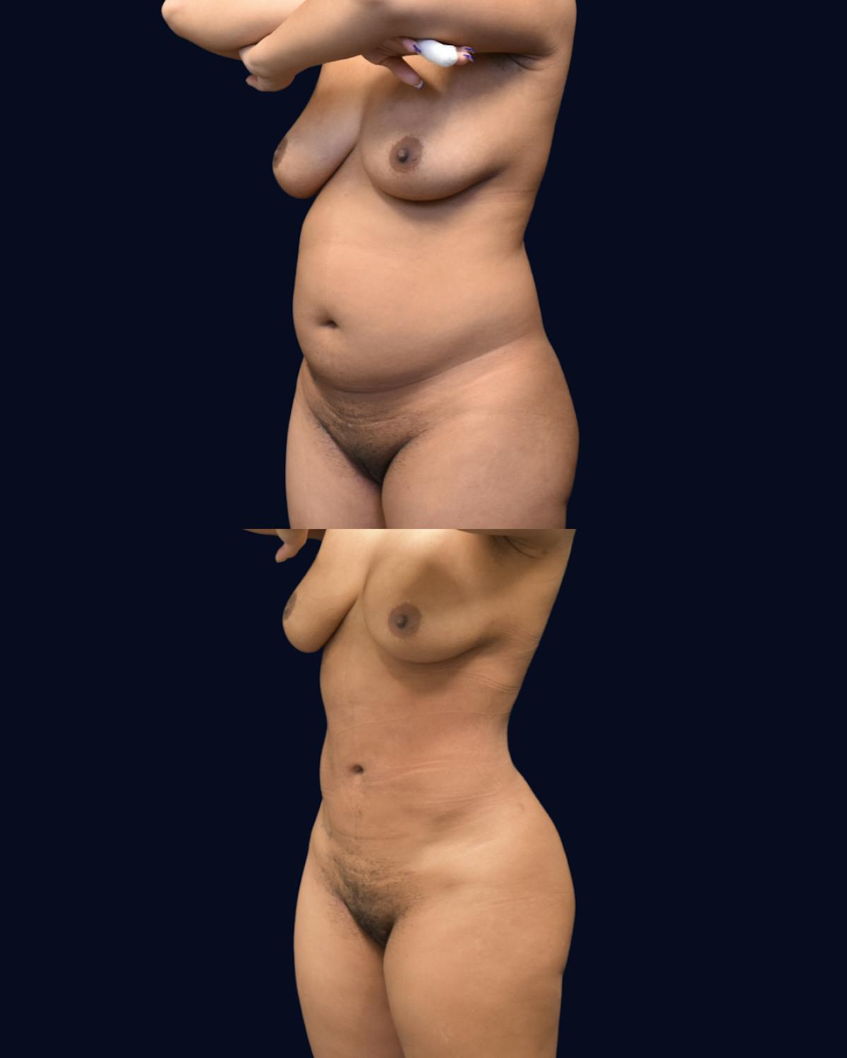 Liposuction Before & After Gallery - Patient 268789 - Image 2