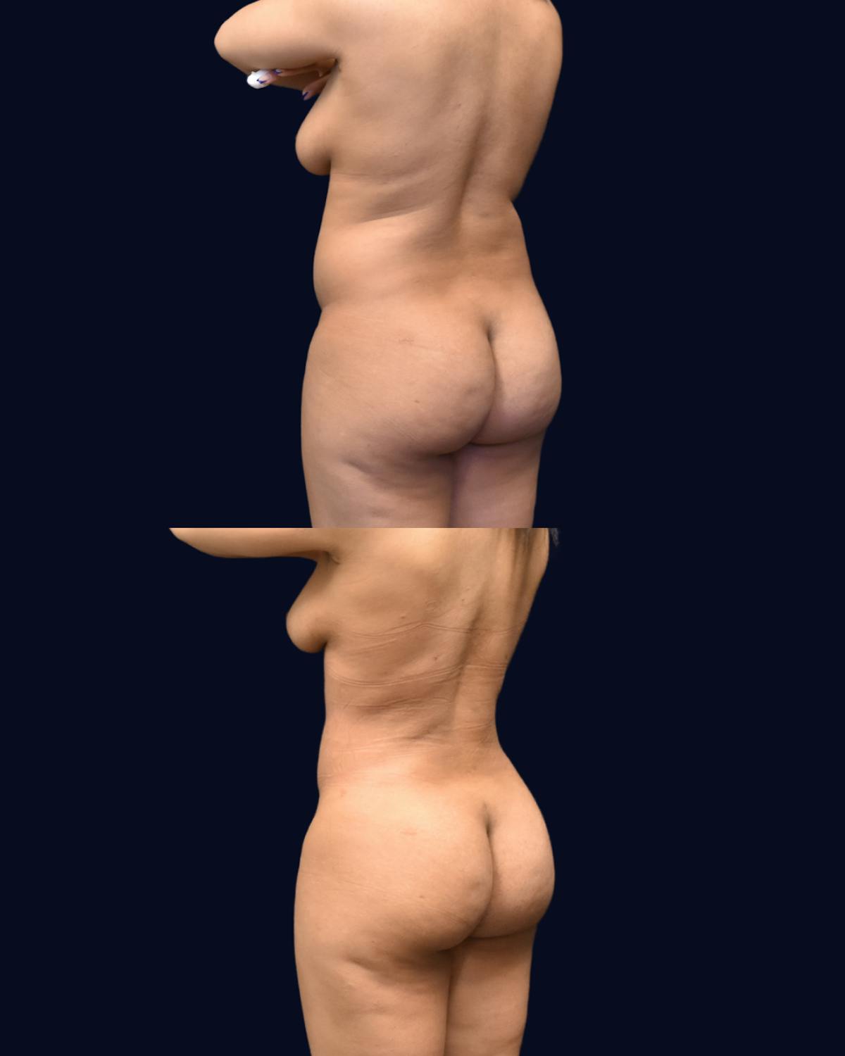Liposuction Before & After Gallery - Patient 268789 - Image 4
