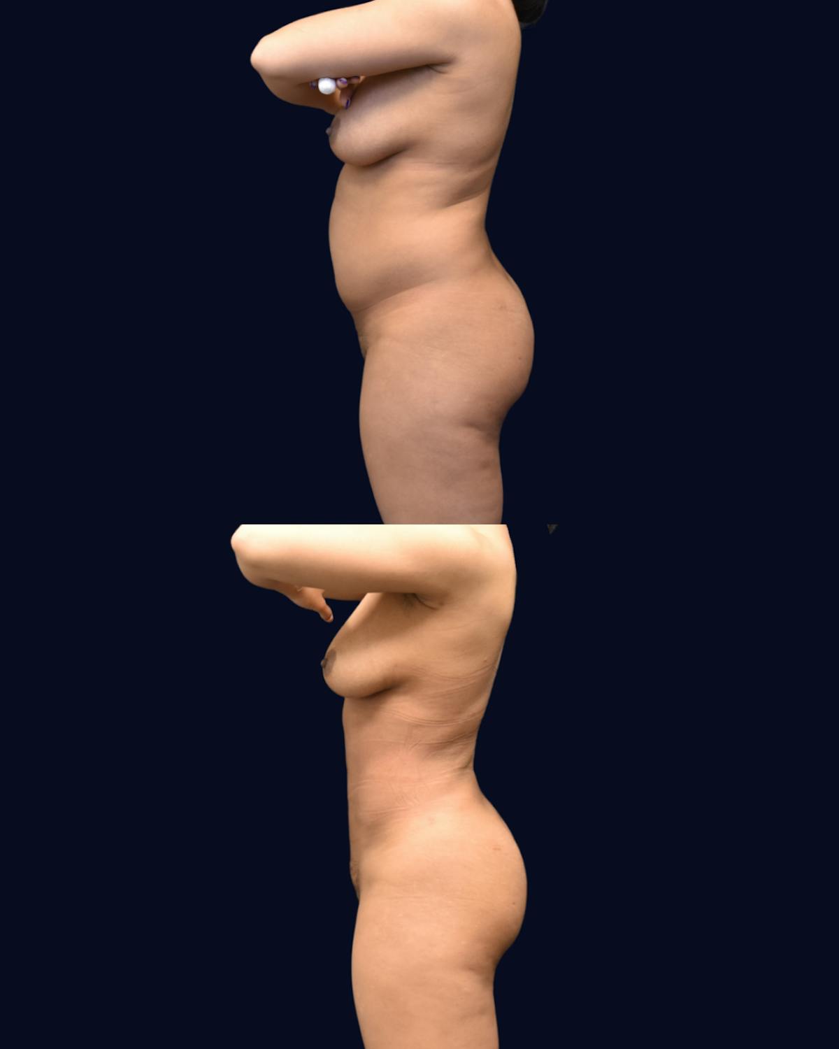 Liposuction Before & After Gallery - Patient 268789 - Image 3