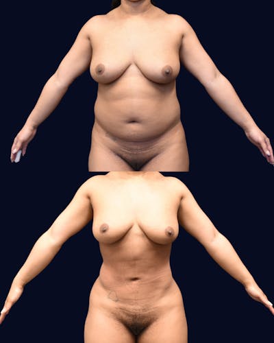 Liposuction Before & After Gallery - Patient 268789 - Image 1