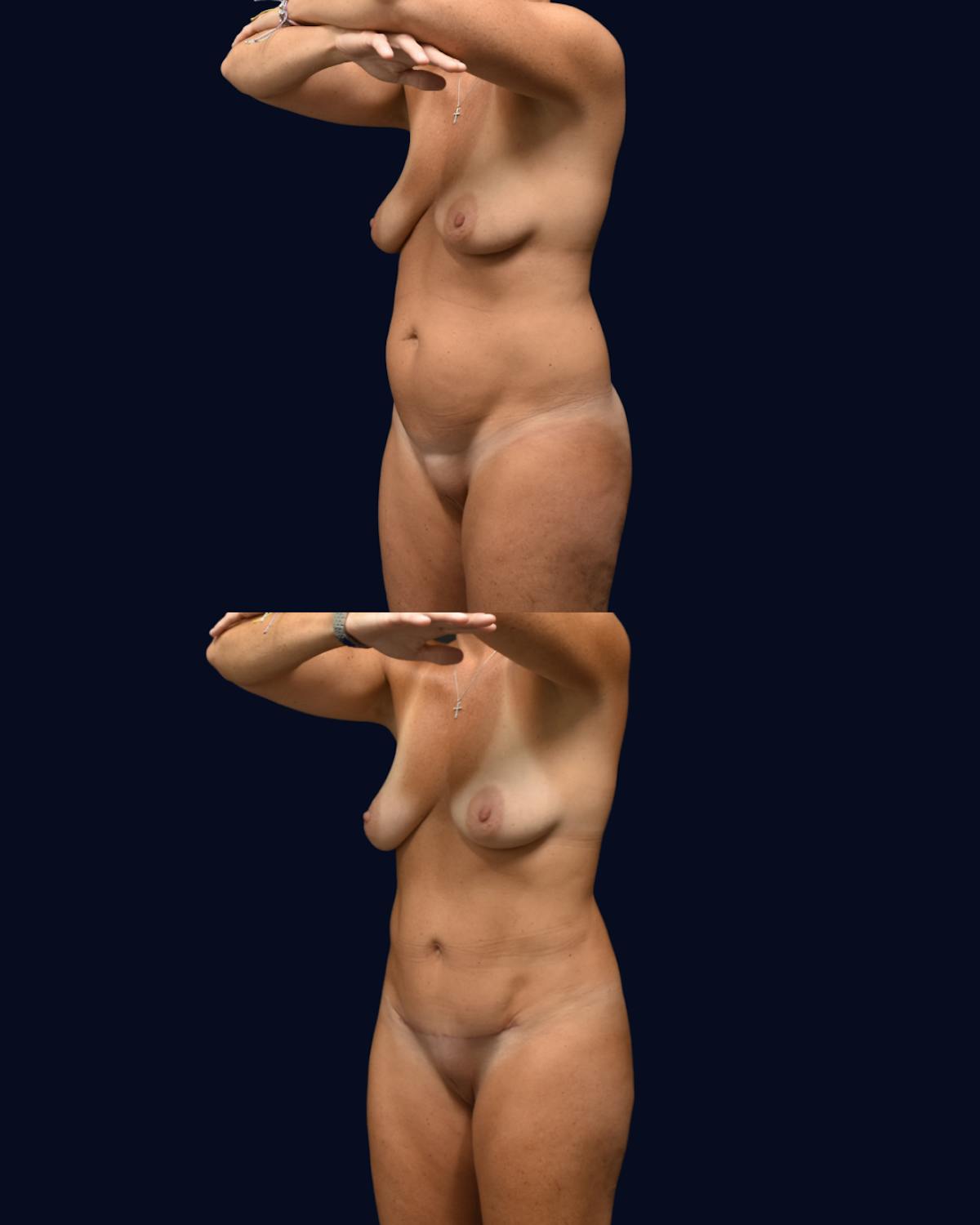 Liposuction Before & After Gallery - Patient 141516 - Image 3