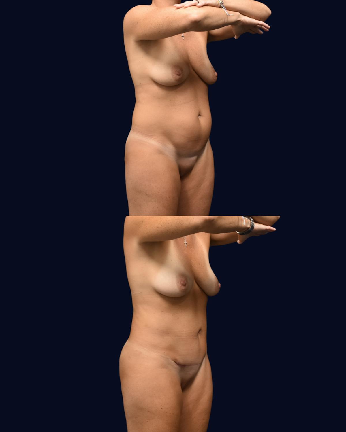Liposuction Before & After Gallery - Patient 141516 - Image 2