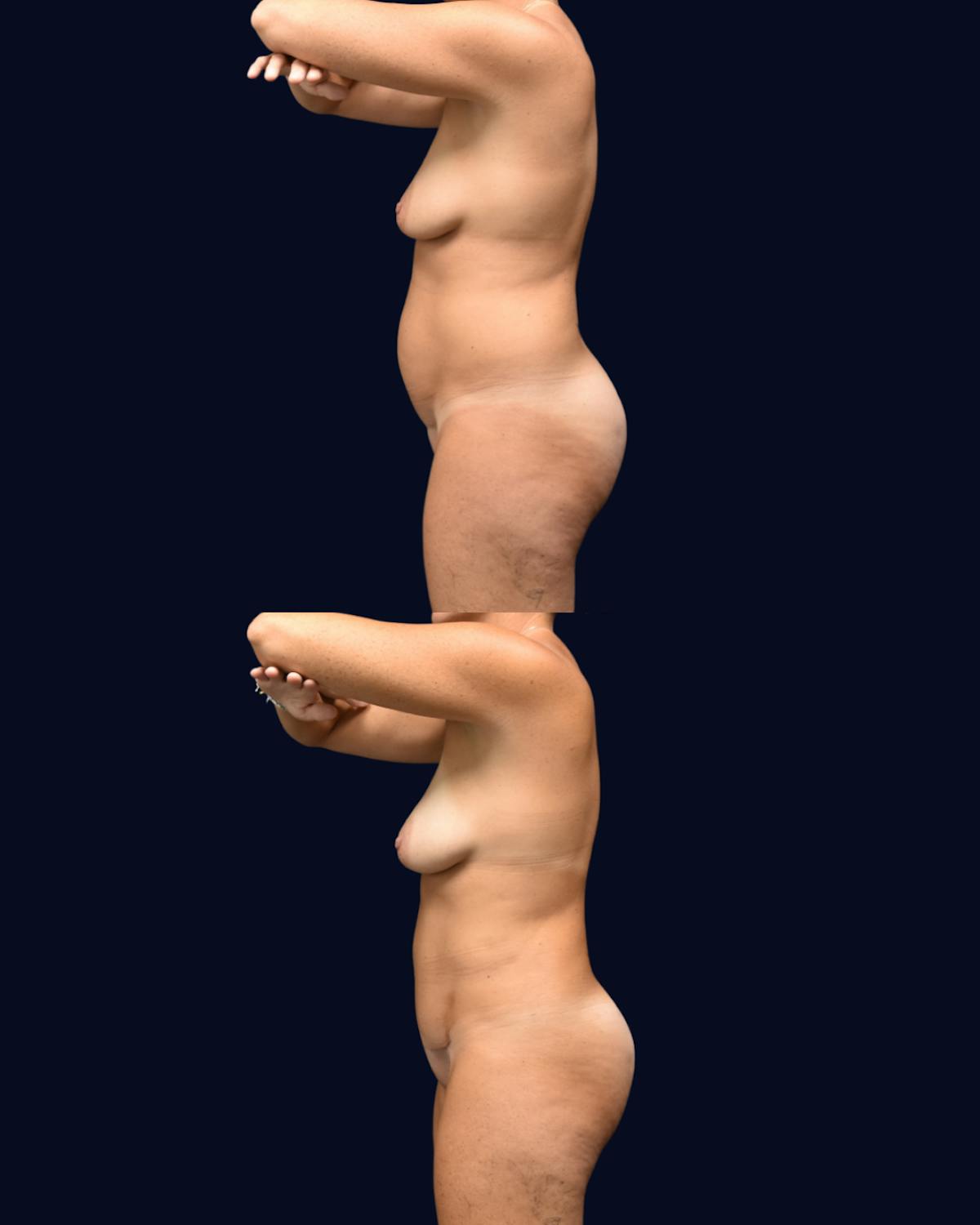 Liposuction Before & After Gallery - Patient 141516 - Image 4