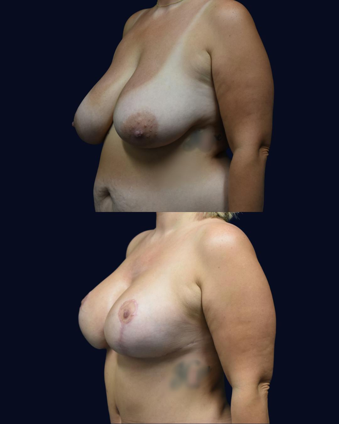 Mommy Makeover Before & After Gallery - Patient 325185 - Image 5