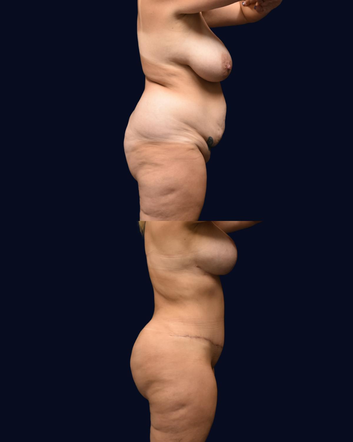 Mommy Makeover Before & After Gallery - Patient 325185 - Image 3