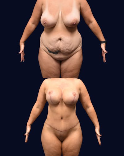 Mommy Makeover Before & After Gallery - Patient 325185 - Image 1