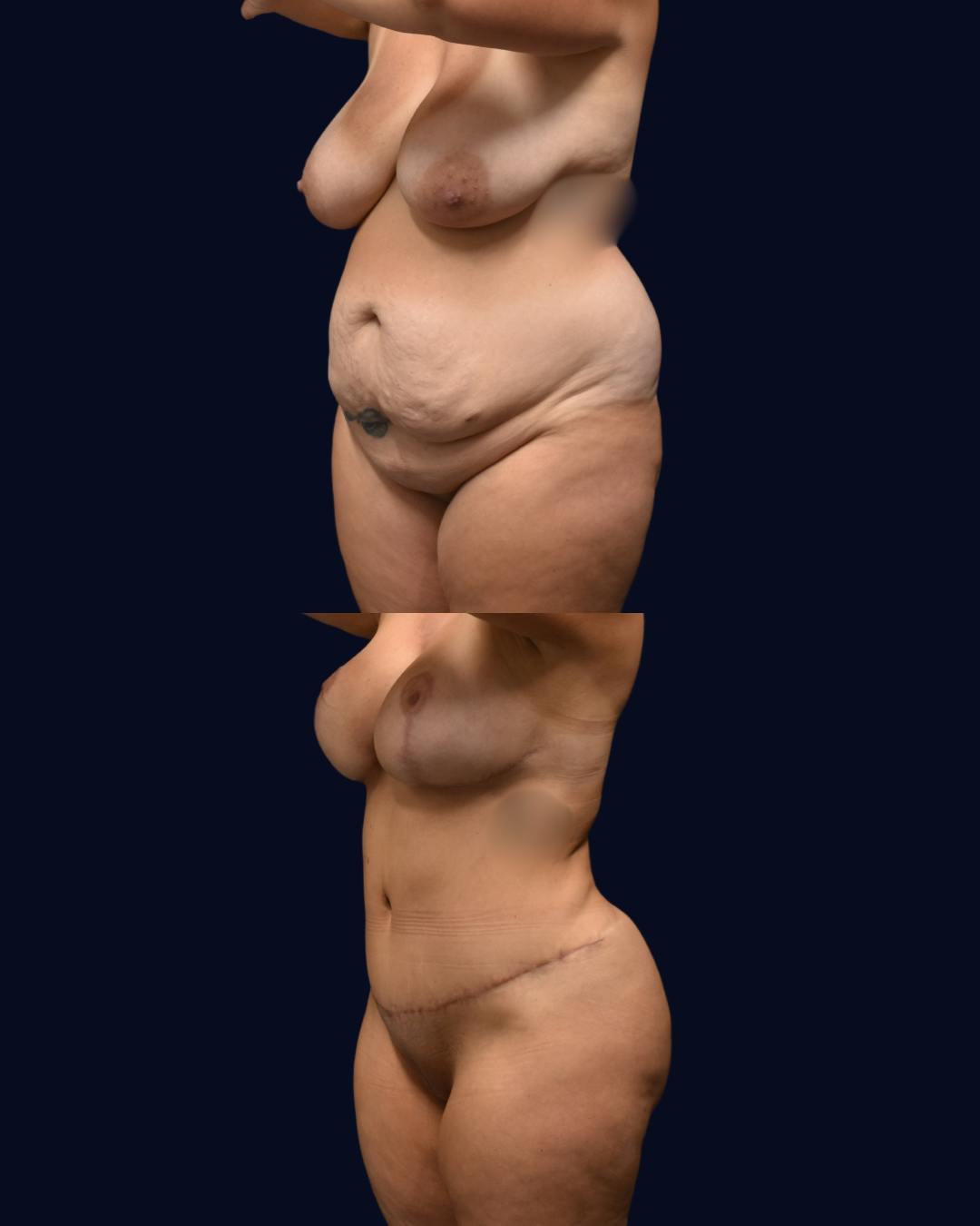 Mommy Makeover Before & After Gallery - Patient 325185 - Image 2