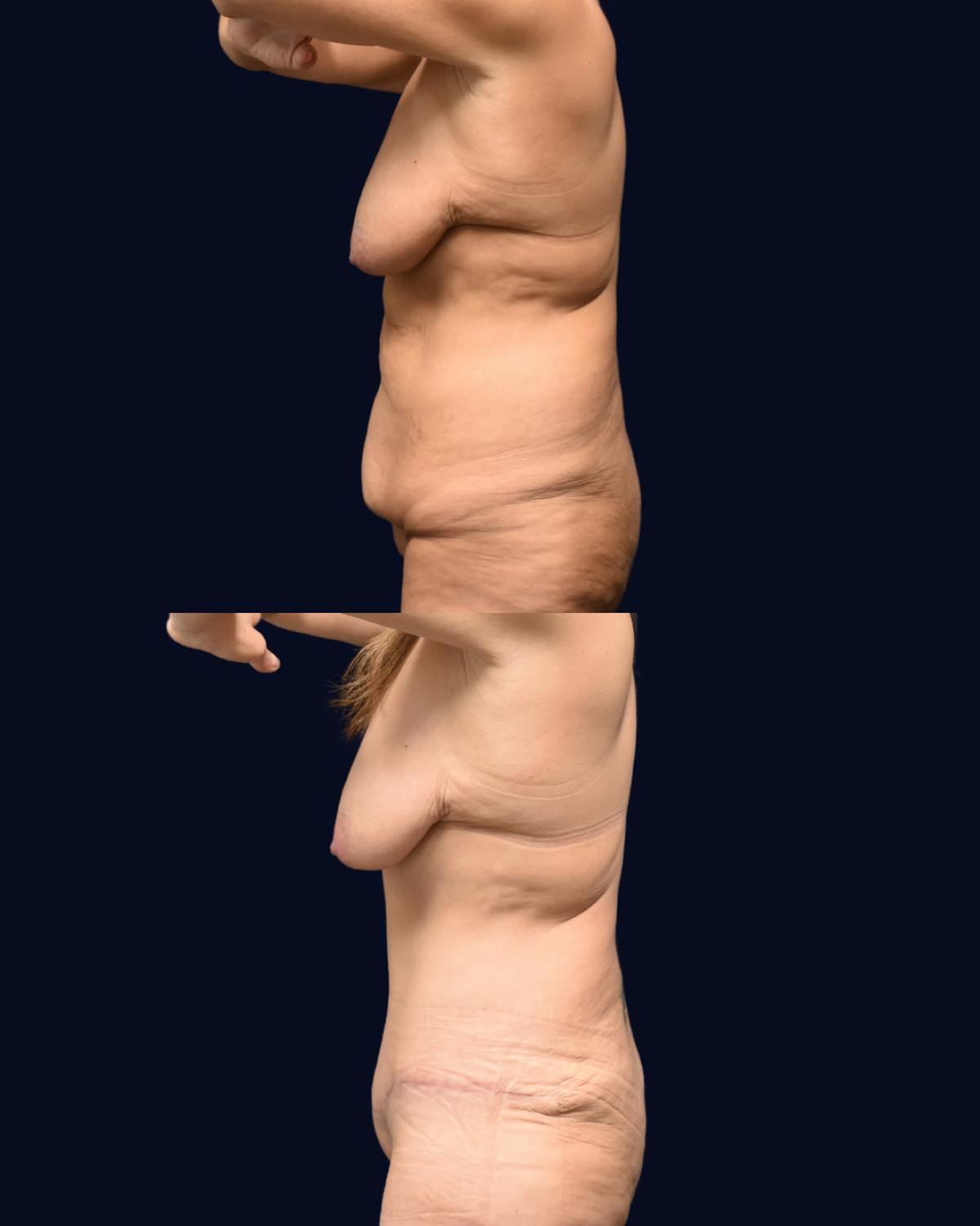 Abdominoplasty with Liposuction Before & After Gallery - Patient 347769 - Image 3