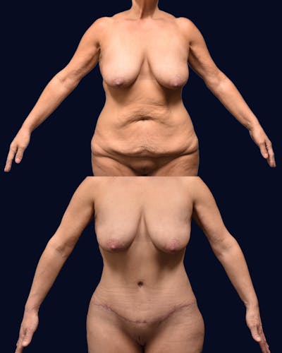 Abdominoplasty with Liposuction Before & After Gallery - Patient 347769 - Image 1