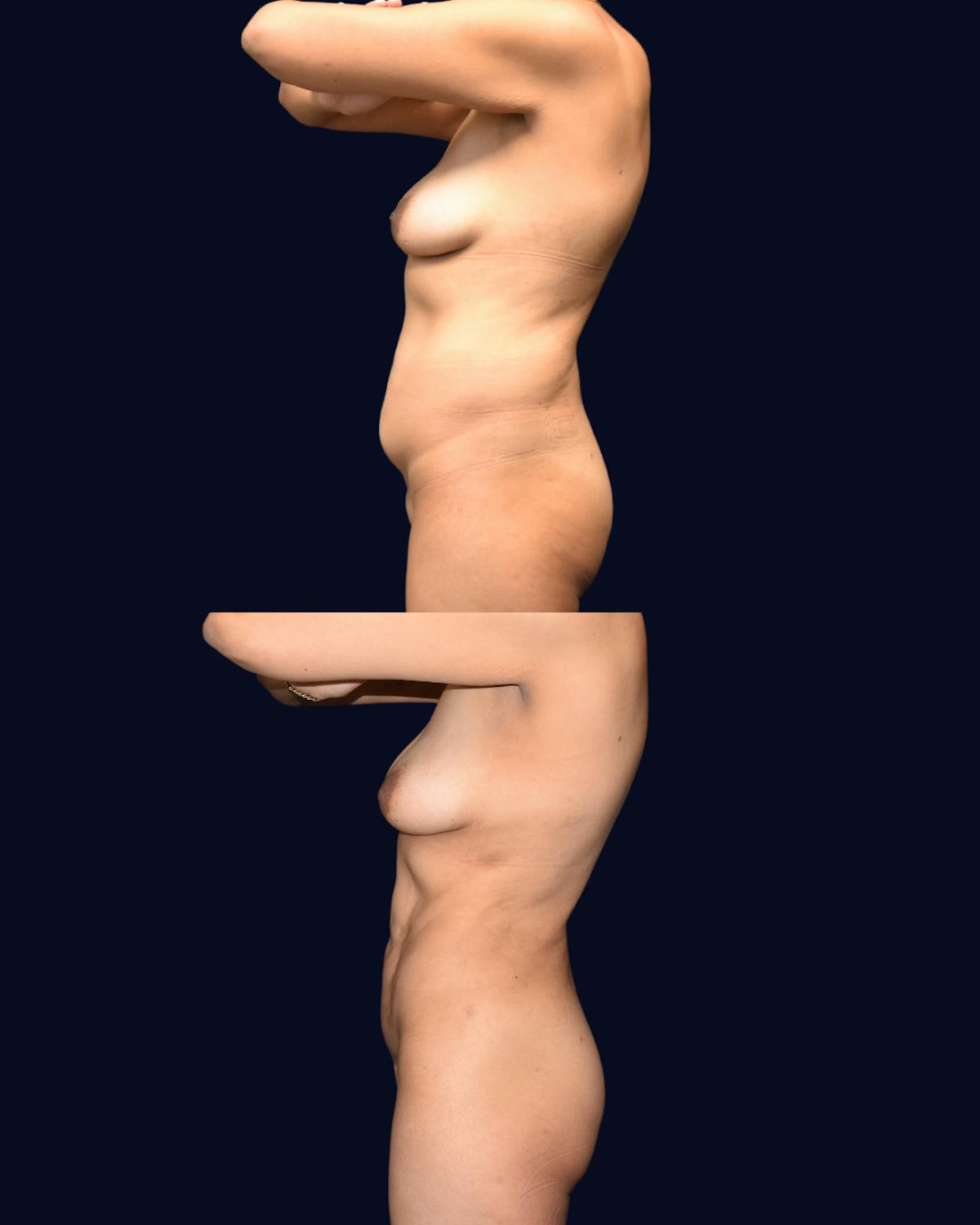 Liposuction Before & After Gallery - Patient 351772 - Image 3