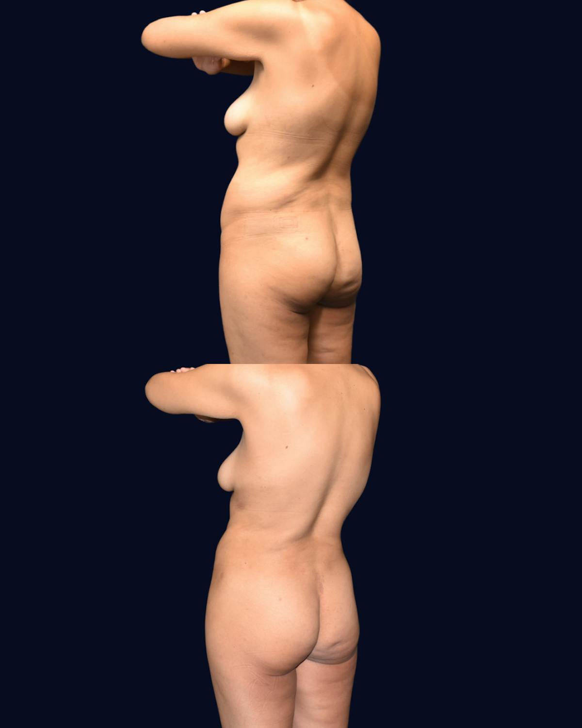 Liposuction Before & After Gallery - Patient 351772 - Image 4