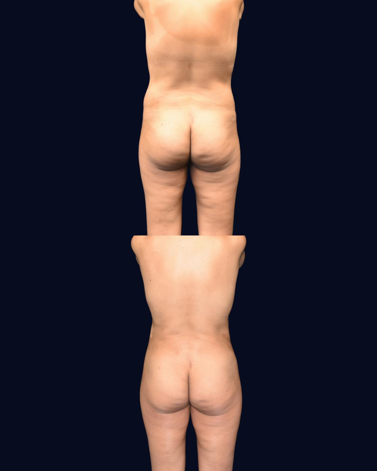 Liposuction Before & After Gallery - Patient 351772 - Image 5