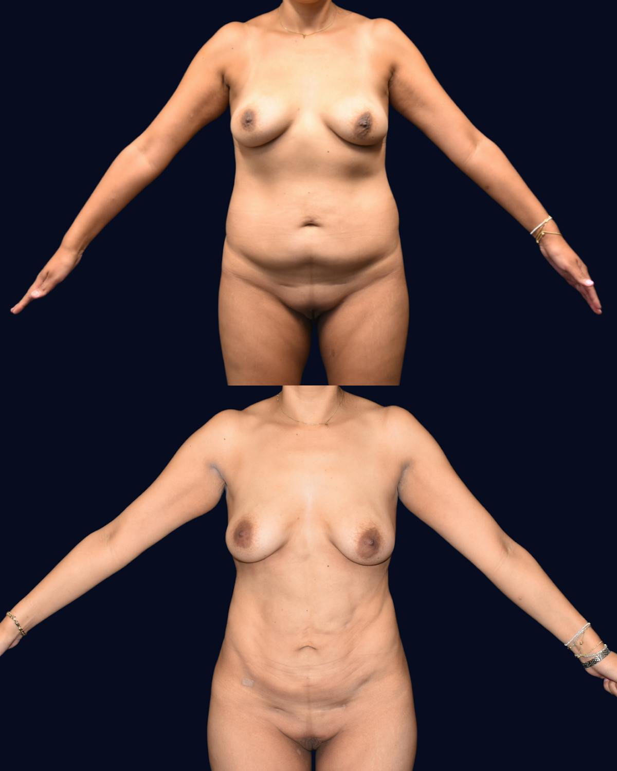 Liposuction Before & After Gallery - Patient 351772 - Image 1