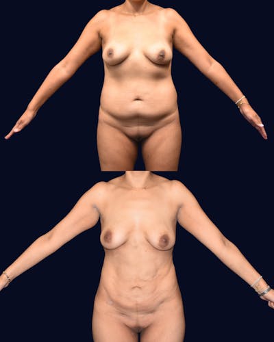 Liposuction Before & After Gallery - Patient 351772 - Image 1