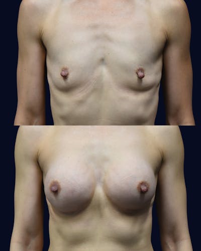Breast Augmentation Before & After Gallery - Patient 351023 - Image 1