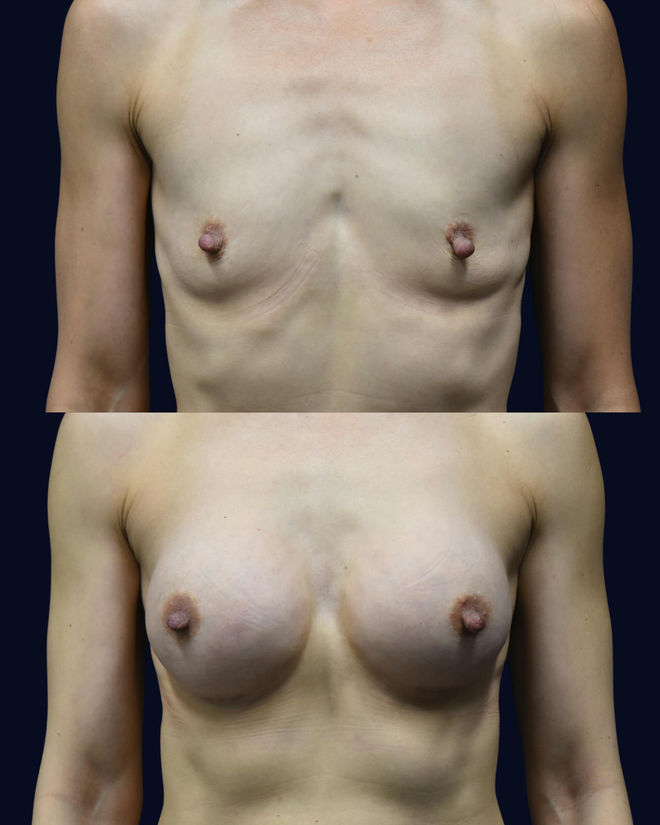 Breast Augmentation Before & After Gallery - Patient 351023 - Image 1