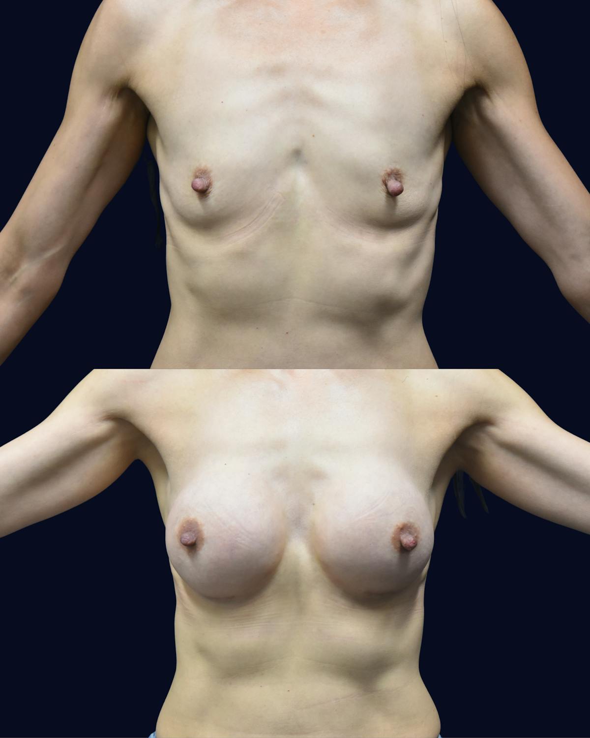 Breast Augmentation Before & After Gallery - Patient 351023 - Image 2