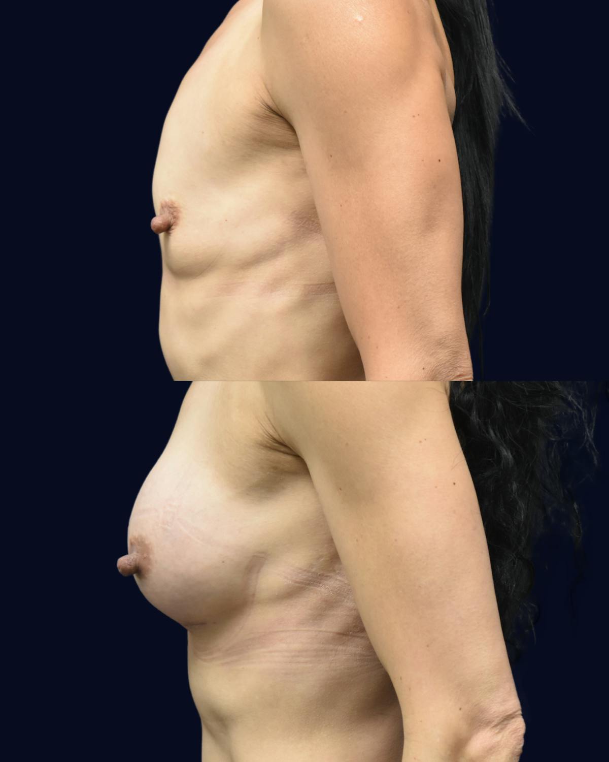 Breast Augmentation Before & After Gallery - Patient 351023 - Image 4