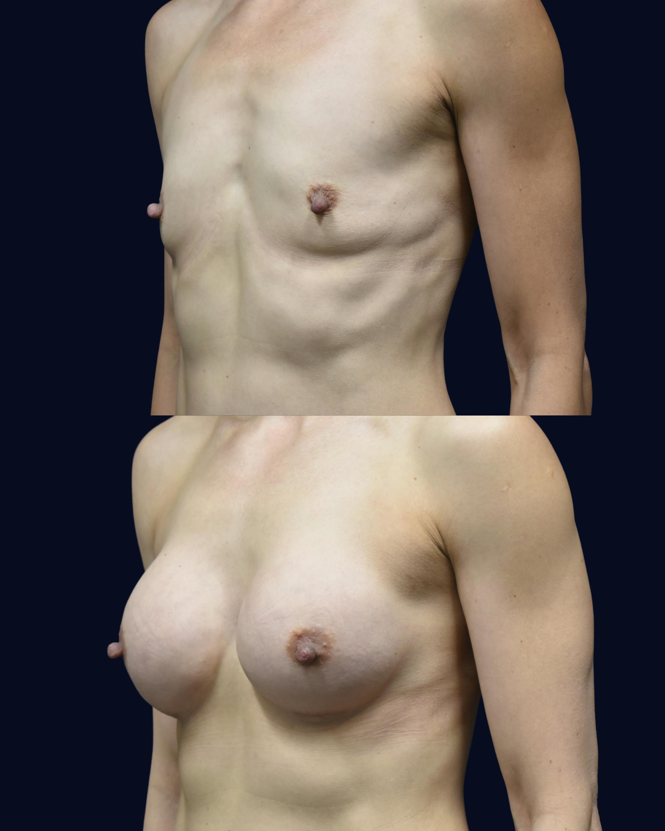 Breast Augmentation Before & After Gallery - Patient 351023 - Image 3