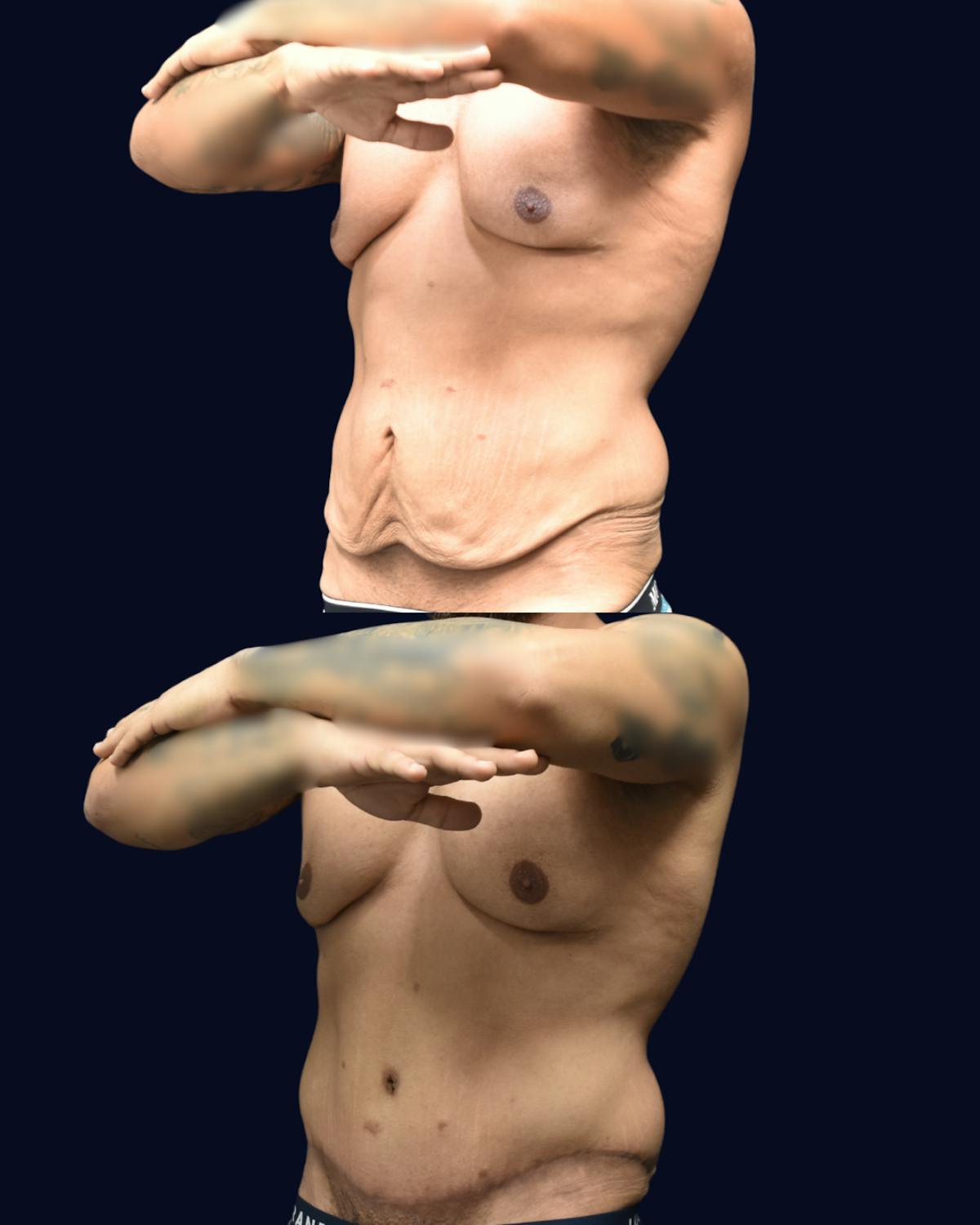 Male Liposuction Before & After Gallery - Patient 964395 - Image 2