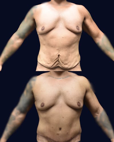 Male Liposuction Before & After Gallery - Patient 964395 - Image 1