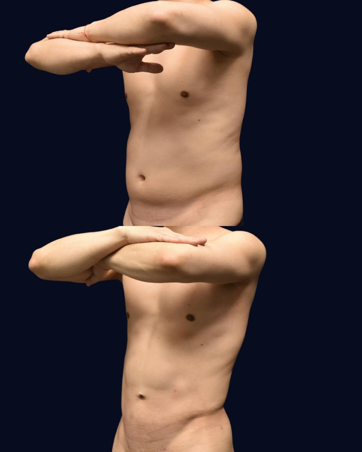 Male Liposuction Before & After Gallery - Patient 257128 - Image 2