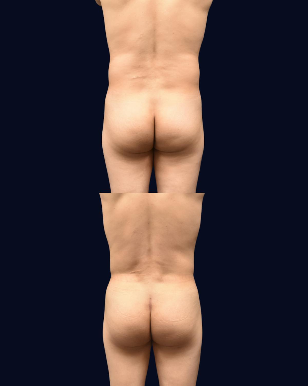 Male Liposuction Before & After Gallery - Patient 257128 - Image 3