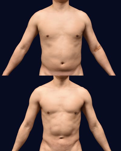 Male Liposuction Before & After Gallery - Patient 257128 - Image 1