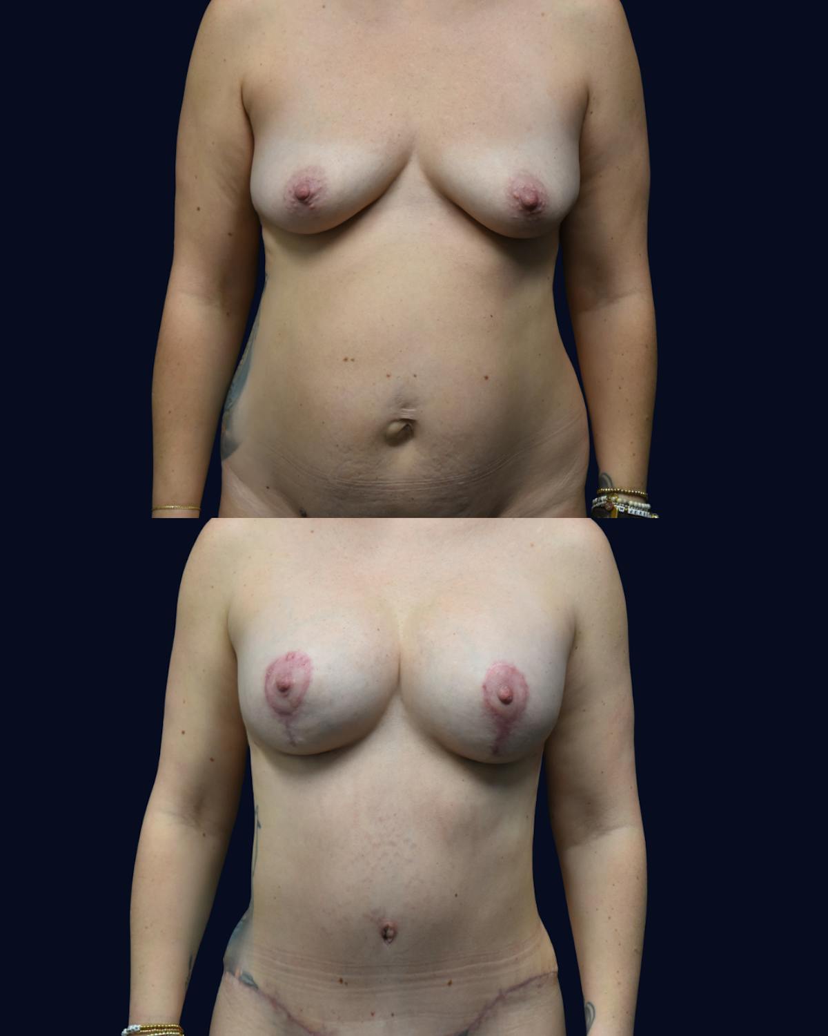 Mommy Makeover Before & After Gallery - Patient 233006 - Image 5