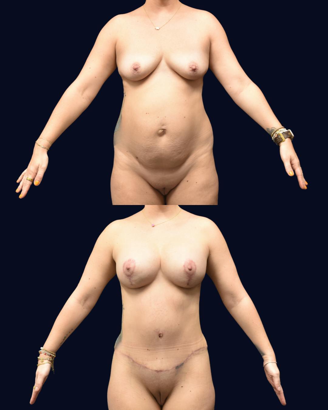 Mommy Makeover Before & After Gallery - Patient 233006 - Image 1