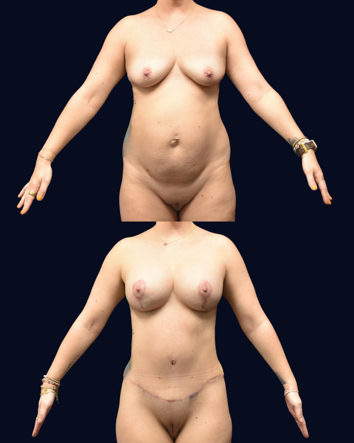 Mommy Makeover Before & After Gallery - Patient 233006 - Image 1