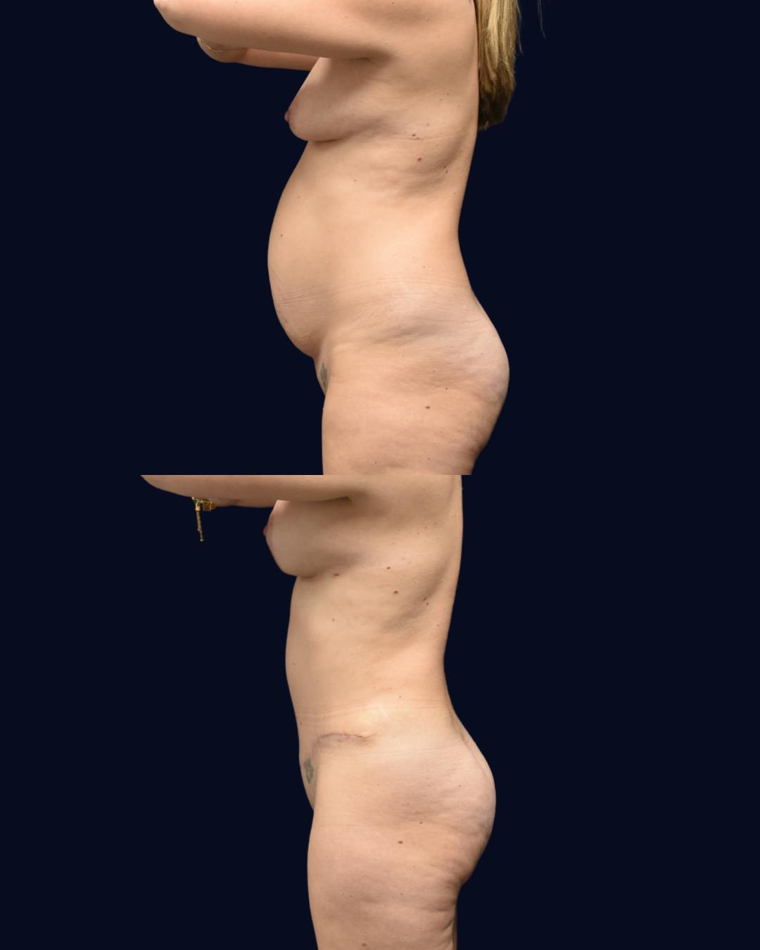 Mommy Makeover Before & After Gallery - Patient 233006 - Image 3