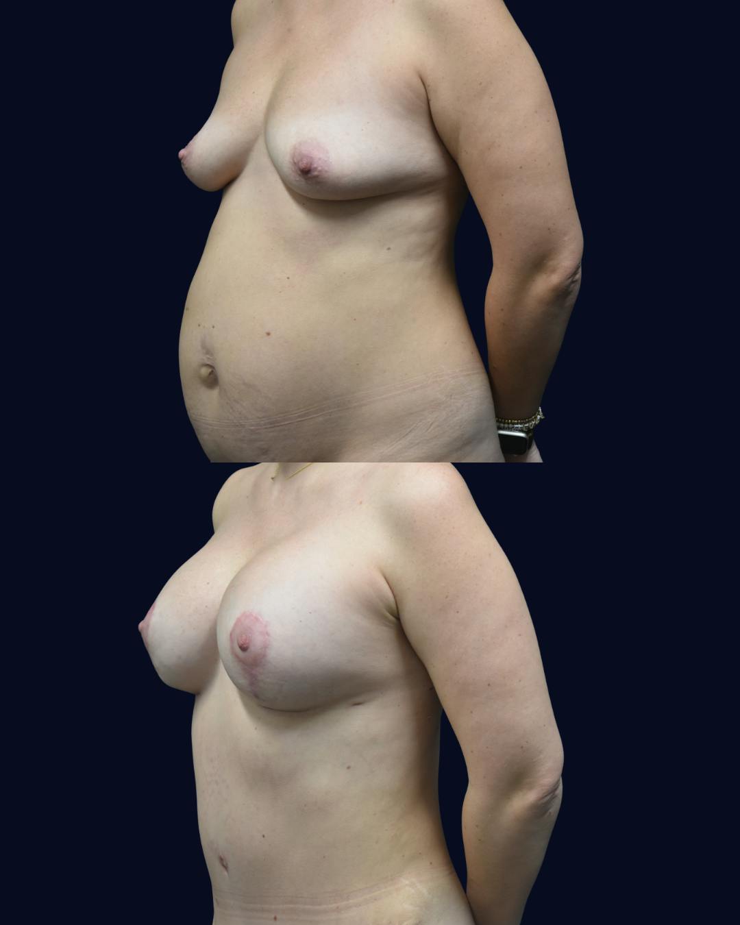Mommy Makeover Before & After Gallery - Patient 233006 - Image 6