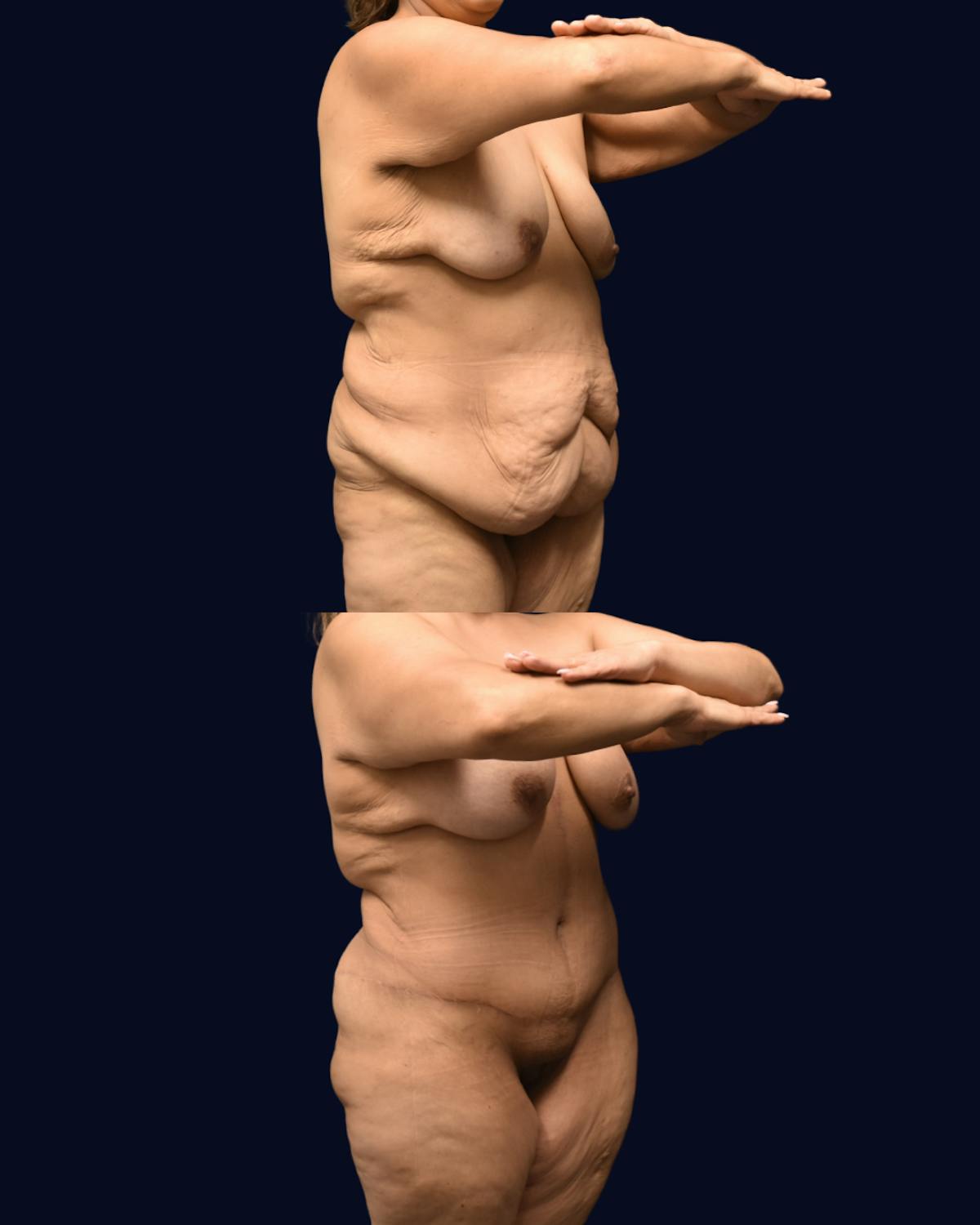 Fleur de Lis Before & After Gallery - Patient 610079 - Image 2