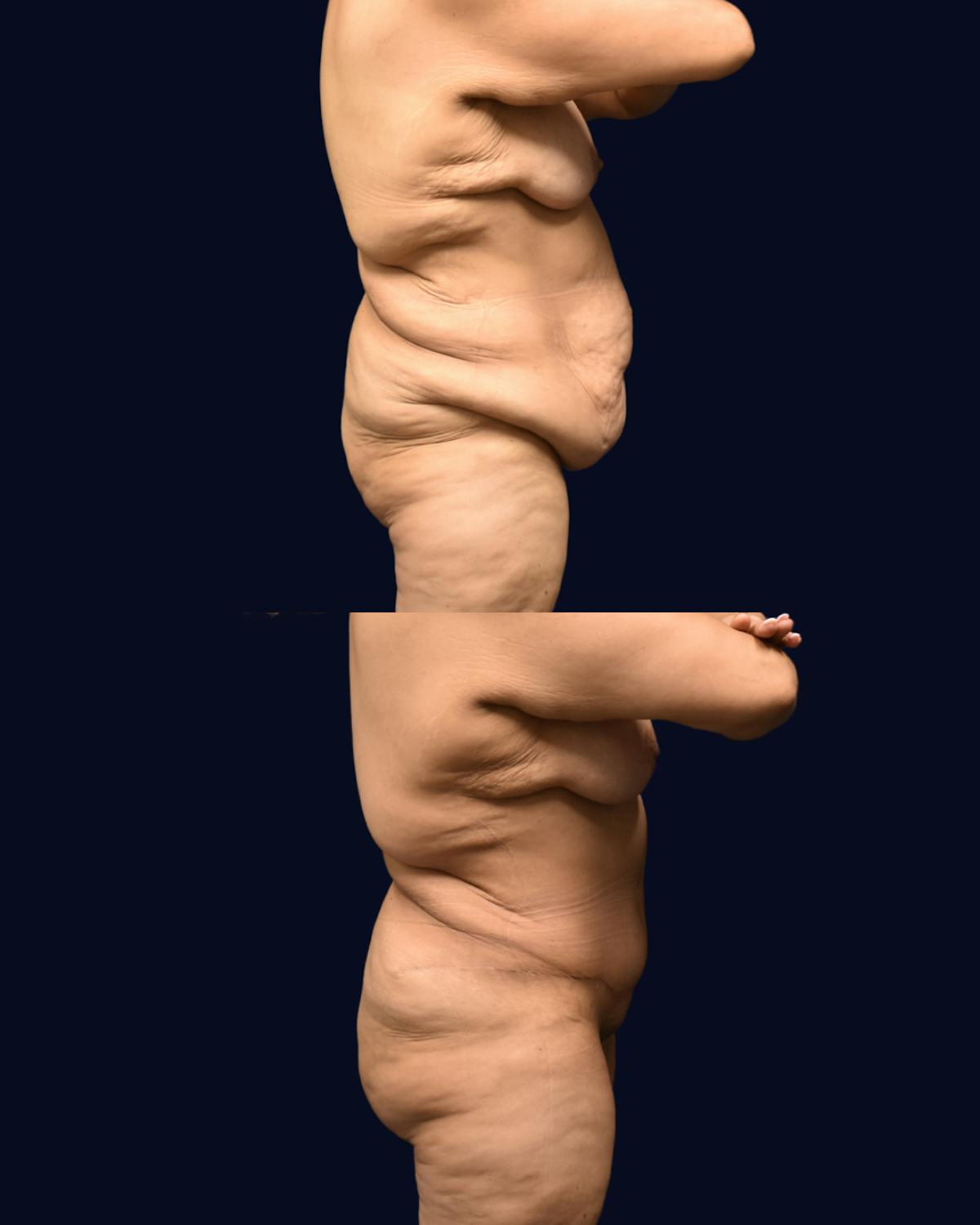 Fleur de Lis Before & After Gallery - Patient 610079 - Image 3