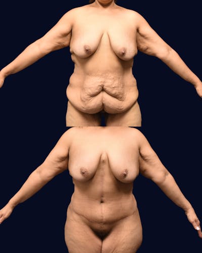 Fleur de Lis Before & After Gallery - Patient 610079 - Image 1